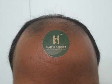 Hair Transplant Case Study